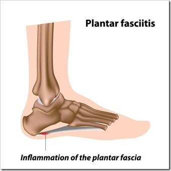 Foot Pain Houston TX Plantar Fasciitis