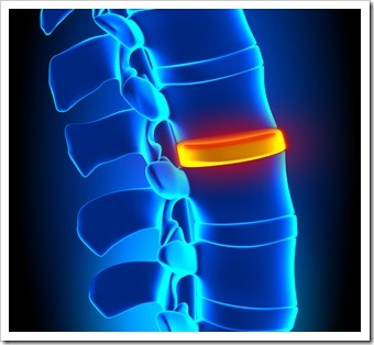 Herniated Disc and Back Pain Westside TX